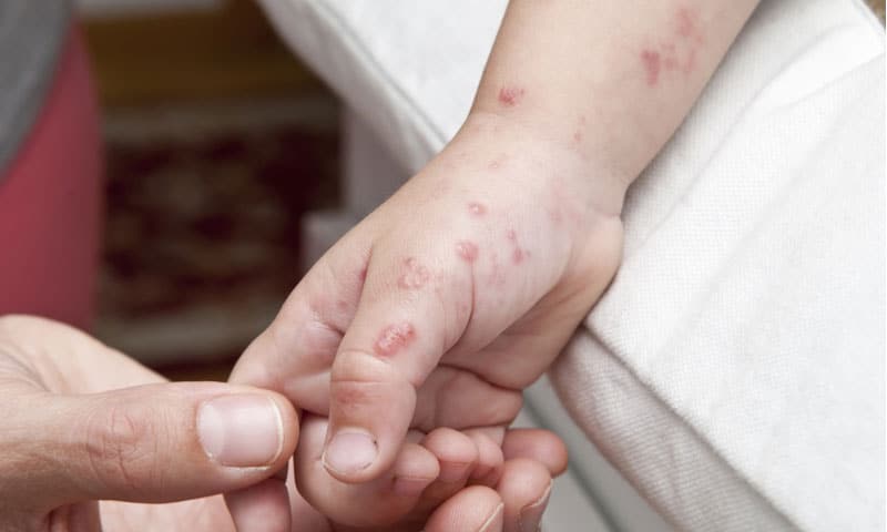 how long is shingles contagious after antibiotics